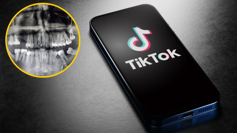 TikToker odkrył u dentysty, że jego kości stały się czarne. Winny jest lek na trądzik
